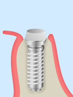 インプラント模式図1