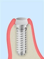 インプラント模式図2