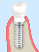 インプラント模式図3