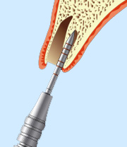 大口式インプラント模式図2